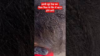 बालों में जुएं देख कर हैरान।।Lice treatment at home lice trending disturbing ytshorts viralshort [upl. by Etsirk315]