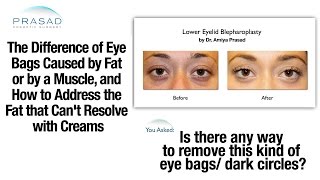 Eye Bags Removal Treatment and What Causes Having Two Kinds of Eye Bags [upl. by Fast935]