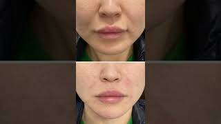 Nasolabial Smile lines Filler filler [upl. by Genni]