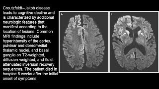 Creutzfeldt–Jakob Erkrankung [upl. by Nance]