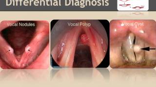 Vocal nodules Inservice [upl. by Atilrac]