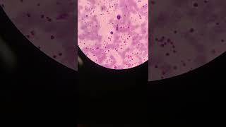 High platelet count platelets clumps  mega platelets  blood smear  mltwithmasood9010 [upl. by Namajneb]