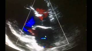 Ecocardiograma Complicaciones del Infarto al miocardio [upl. by Pfaff]