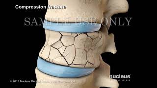 Back Surgery  Vertebroplasty and Kyphoplasty  Nucleus Health [upl. by Lilli176]