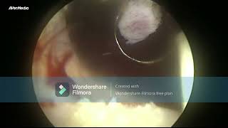 TURP transurethral resection of prostate 80 GM [upl. by Godfree784]