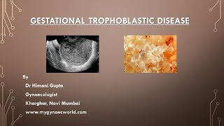 Gestational Trophoblastic Disease  Video SeriesEpi1 [upl. by Craw]