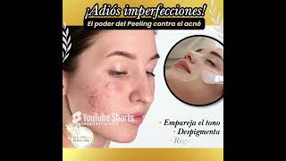 ¡El acné en tu cuerpo tiene solución en Paloma Clinic acne laseriplacne laseracne ipl luz [upl. by Nnyleimaj]