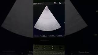 Bedside clinical imageology 1 60F with acute heart failure and comorbidities after covid like viral [upl. by Chamberlin97]