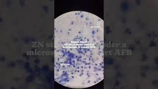 ZN stain smear to report AFB reels reel reaction reels reel story shortvideo shorts short [upl. by Zerdna]