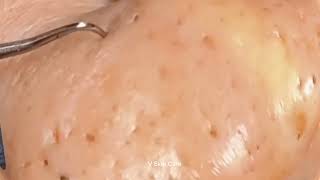 Remove ACNE FAST With These Treatment Secrets get Rid Acne and welcome Glowing Skin Face [upl. by Bor993]