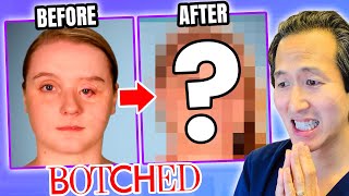 Plastic Surgeon Reacts to BOTCHED Incredible Eye Reconstruction [upl. by Abbi85]