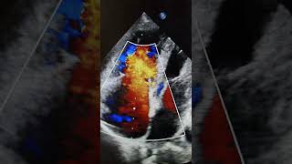 Vegetation on Anterior leaflet of tricuspid Valve vegetation echo echocardiography heartdisease [upl. by Nilde]