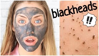 SKIN GRITTING  CRAZY Blackhead Removal Method [upl. by Maridel258]