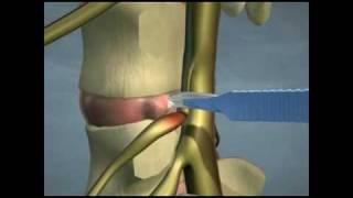 Lumbar Disc Herniations [upl. by Sirdi]