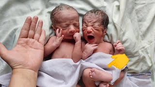 Special Twins Newborn babies with multiple anomalies after birth equal to Human Hand [upl. by Maher]