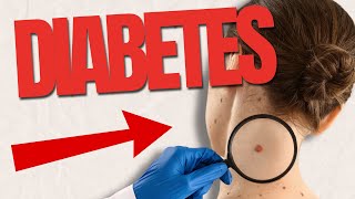 10 UNEXPECTED Signs Of Diabetes On The Skin [upl. by Samale171]