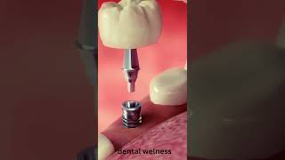 Get PERFECT Smiles with This Implant Placement Procedure shorts [upl. by Noelc781]