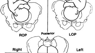 اسهل طريقة لتحديد malposition and malpresentation  مادة توليد obstetrics [upl. by Olympe56]