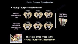 Pelvic Fractures  Everything You Need To Know  Dr Nabil Ebraheim [upl. by Katina210]