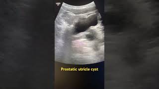 Prostatic utricle cyst prostatetrasound radiology radiography ultrasoundmadeeasy [upl. by Rosco]