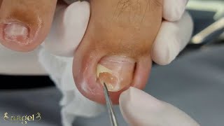 🥺UNHA ENCRAVADA NOS DOIS CANTOS hoje vídeo completo😍 nails ingrowntoenail [upl. by Alcine105]