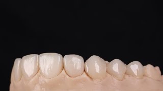 Making temporary dental veneers Mock up transfer [upl. by Etnoel]