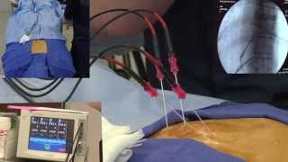 Radiofrequency Ablation Explanation Video Demonstration  LIVE [upl. by Leinnad649]