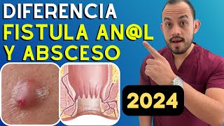 🚩 Absceso y Fistula anorrectal Diferencias Diagnostico y Tratamiento Resumido 2024 [upl. by Yesak3]