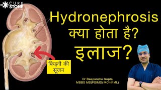 Hydronephrosis Treatment in Hindi क्या होता है kidney की सूज़न HYDRONEPHROSIS Dr Deepanshu Gupta [upl. by Yramanna]