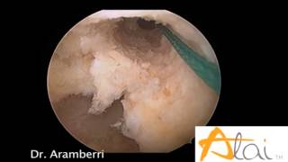 Rotura de ligamento cruzado anterior Artroscopia ACL tear Arthroscopy [upl. by Pierrette562]