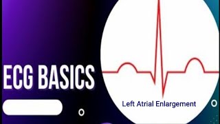 ECG Basics  Left Atrial Enlargement ECG Changes in Left Atrial Enlargement [upl. by Eimareg]