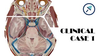 Brain herniations  Case 1 [upl. by Fusuy]