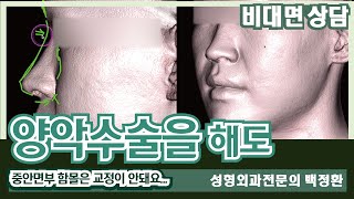 SUB 양악수술해도 중안면부 함몰은 교정 안돼요 비대면상담 201 両顎手術をしても中顔面部の陥没は治りません…オンライン相談201 [upl. by Holman]