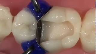 White Composite Filling a Molar  Rajan Dental [upl. by Enyt116]