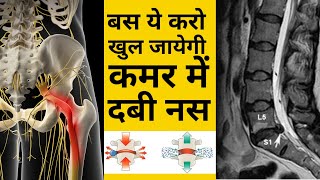 बस ये करो ठीक हो जाएगी कमर में दबी नस  L4L5 disc Bulge  SCIATICA  DABI NAS  leg pain  Hip pain [upl. by Navada]