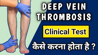 Deep vein thrombosis Clinical Examination  Homans Test for DVT [upl. by Davida]