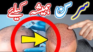 Hair Transplant ki Waja Se Skin Numbness 4 Saal Se  kya galati hovi [upl. by Quintessa]