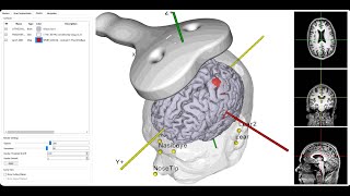 Unlocking the Power of rTMS A Breakthrough in Treating TreatmentResistant Depression [upl. by Lewison178]