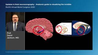 Updates in fetal neurosonography an anatomic guide to visualizing the invisible [upl. by Ahsekyt167]