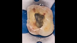 Maxillary Molar Access Opening [upl. by Chrisy81]