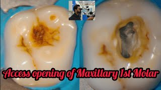 Access opening of Maxillary 1st Molarstep by step rootcanal treatment [upl. by Noremak946]