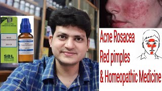 Acne Rosacea  Red Pimples  Homeopathic medicine for Rosacea  explain [upl. by Hoisch997]