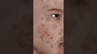 What Exactly Is Acne Causes of Acne 3D Animation [upl. by Tips]