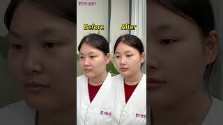 Notice the amazing skin and body transformation 😍 CavitationMachine FacialDevice AntiAging [upl. by Neri]