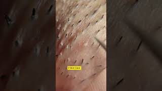 Remove ACNE FAST With These Treatment Secrets 102 dermatologia acne blackheads [upl. by Amal]