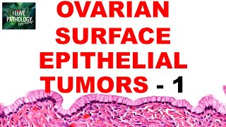 OVARIAN TUMORS  Part 2  SEROUS AND MUCINOUS TUMORS Etiopathogenesis and morphology [upl. by Otxis]