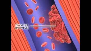 Formation of Deep Vein Thrombosis [upl. by Arem]