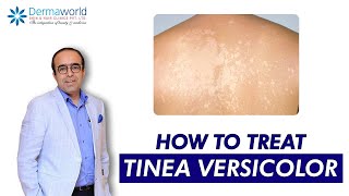 Tinea versicolor  Dr Rohit Batra  Tinea Versicolor Treatment  How to treat Tinea Versicolor [upl. by Ketchum]