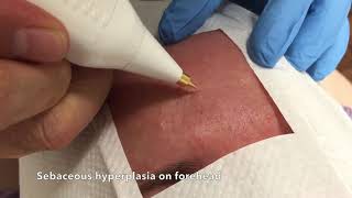 Sebaceous hyperplasia removal [upl. by Eidurt633]