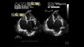 CHF with systolic and severe diastolic dysfunction [upl. by Perrie]